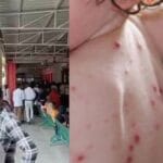 गोरखपुर में 'टोमेटो फीवर' की दस्तक