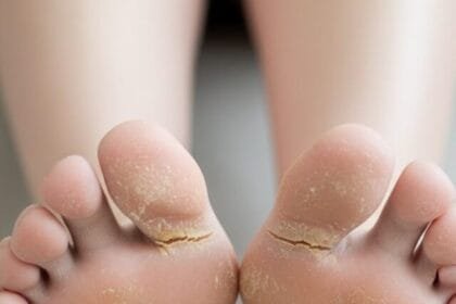 सर्दियों में फटी एड़ियों से बचने के घरेलू उपाय